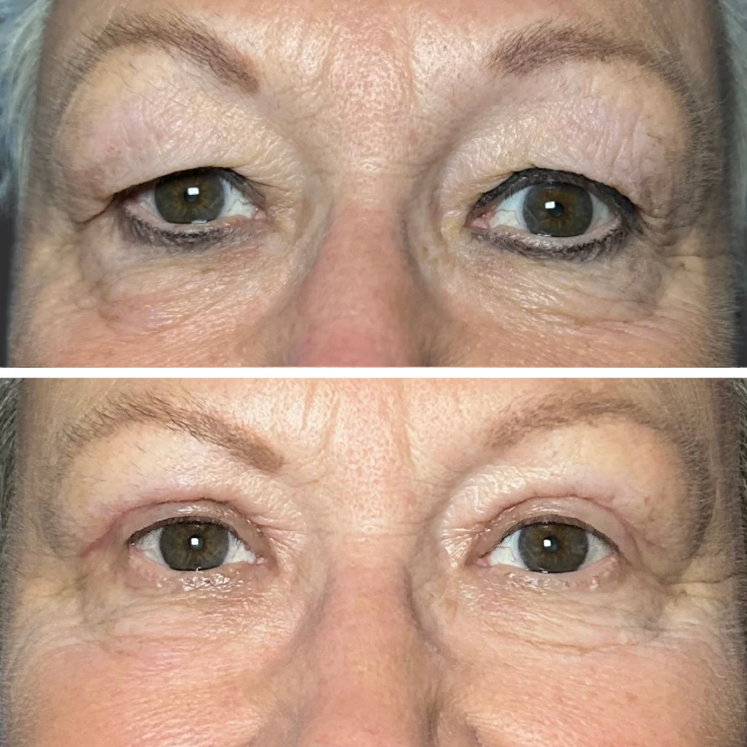 Blepharoplasty Patient Results Case 1