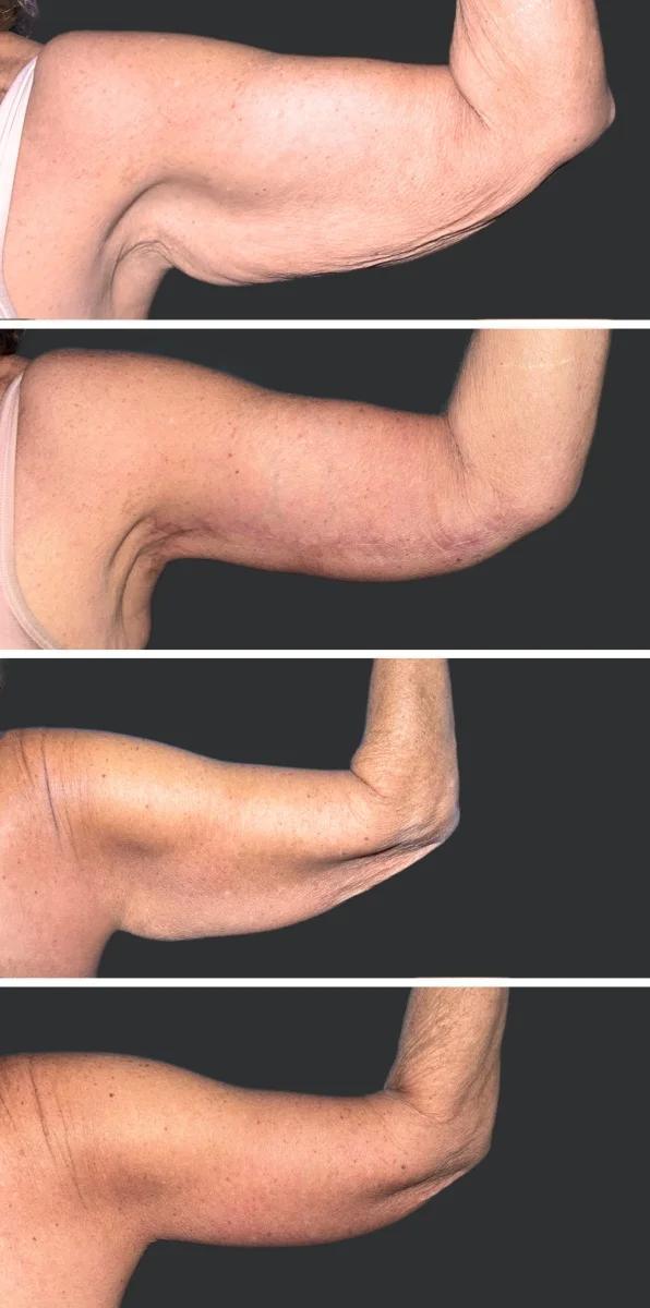 Brachioplasty Patient Results Case 1