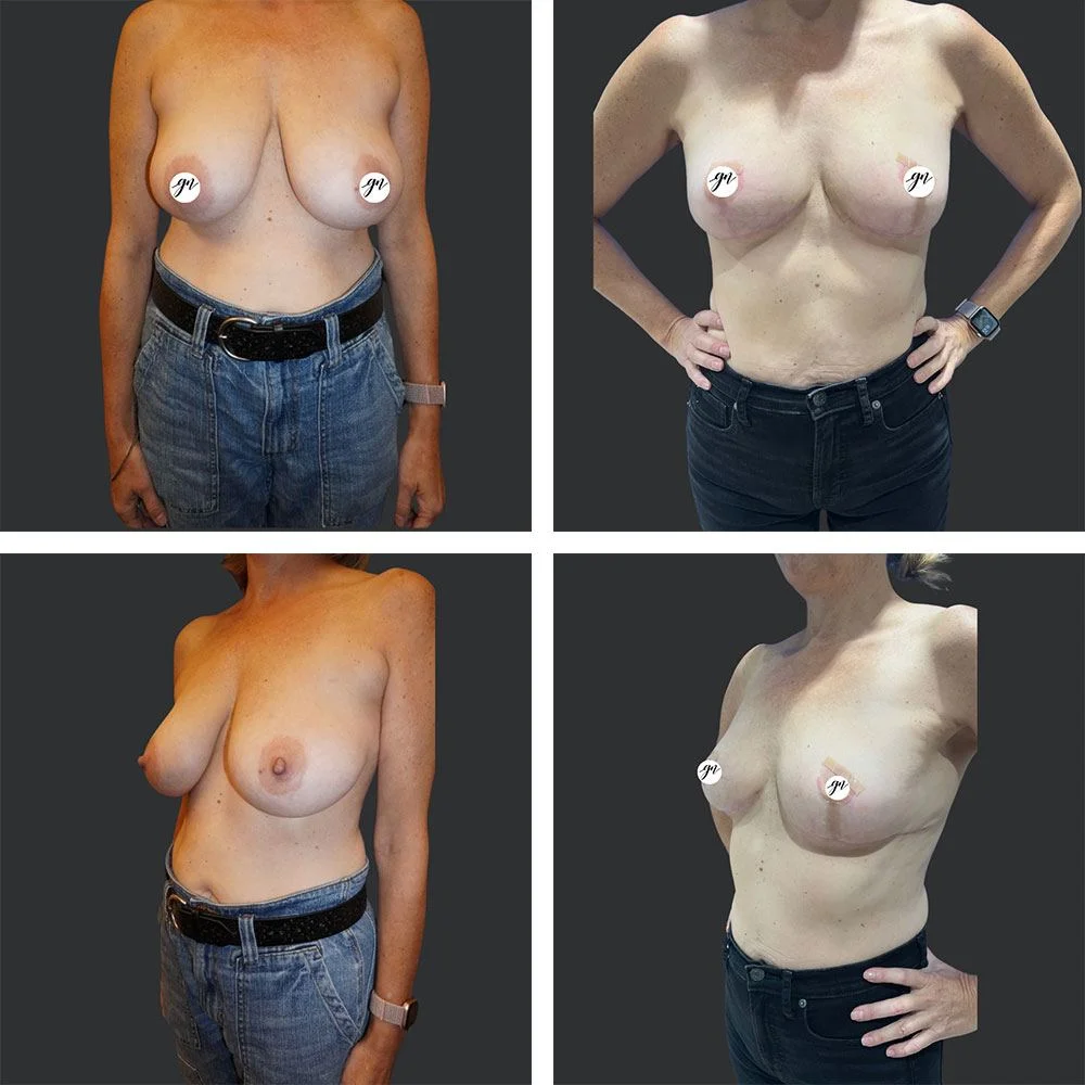 Breast Lift Patient Results Case 1