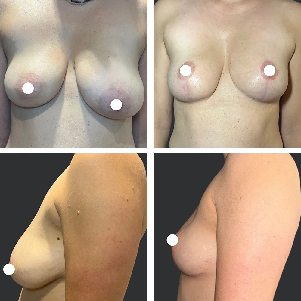 Breast Lift Patient Results Case 2