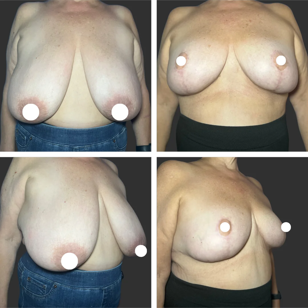Breast Reduction Patient Results Case 3