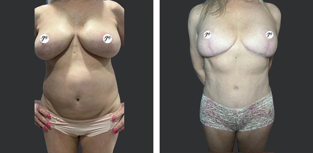 Breast Reduction Patient Results Case 5