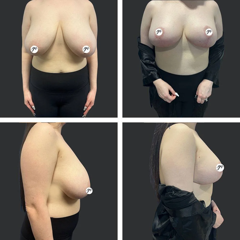 Breast Reduction Patient Results Case 6