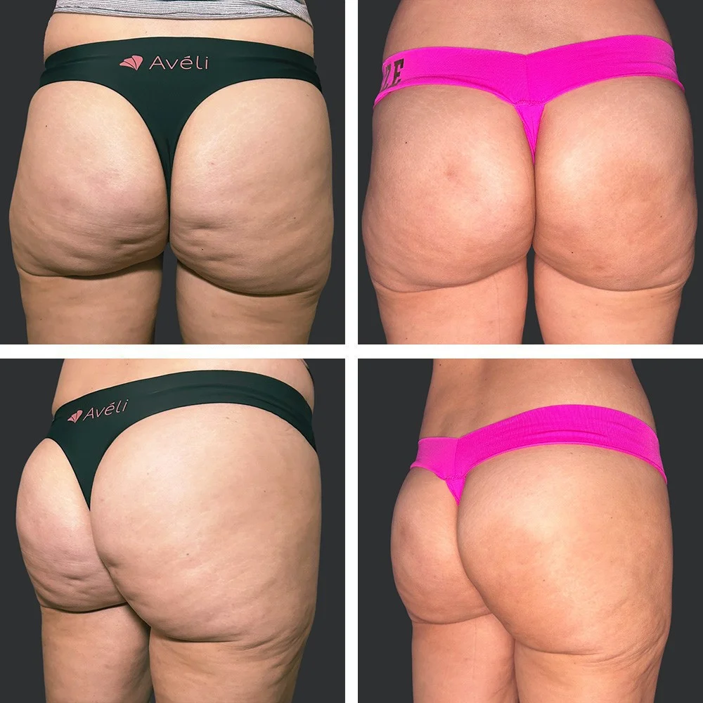 Cellulite Treatment Patient Results Case 1