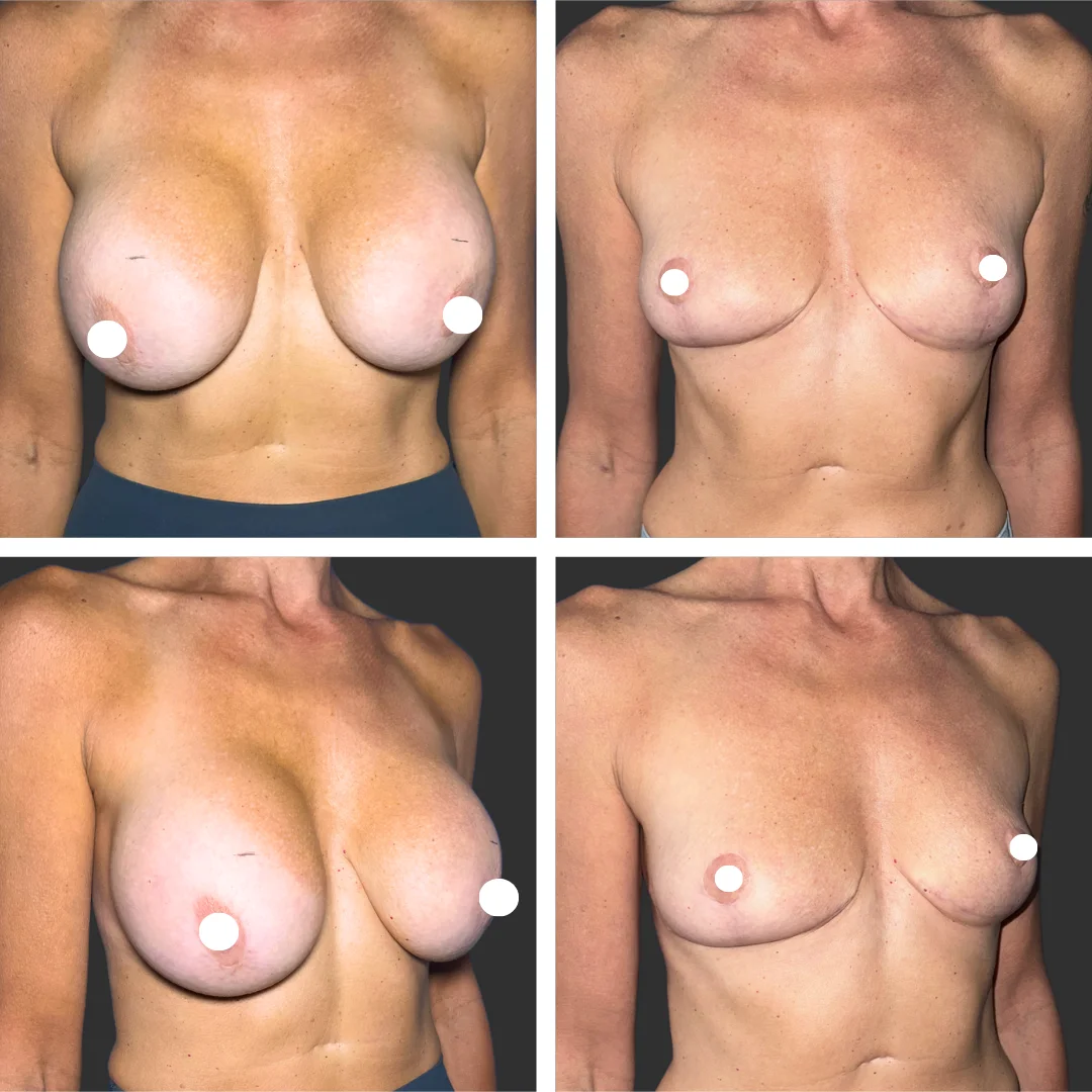 Implant Removal Patient Results Case 1