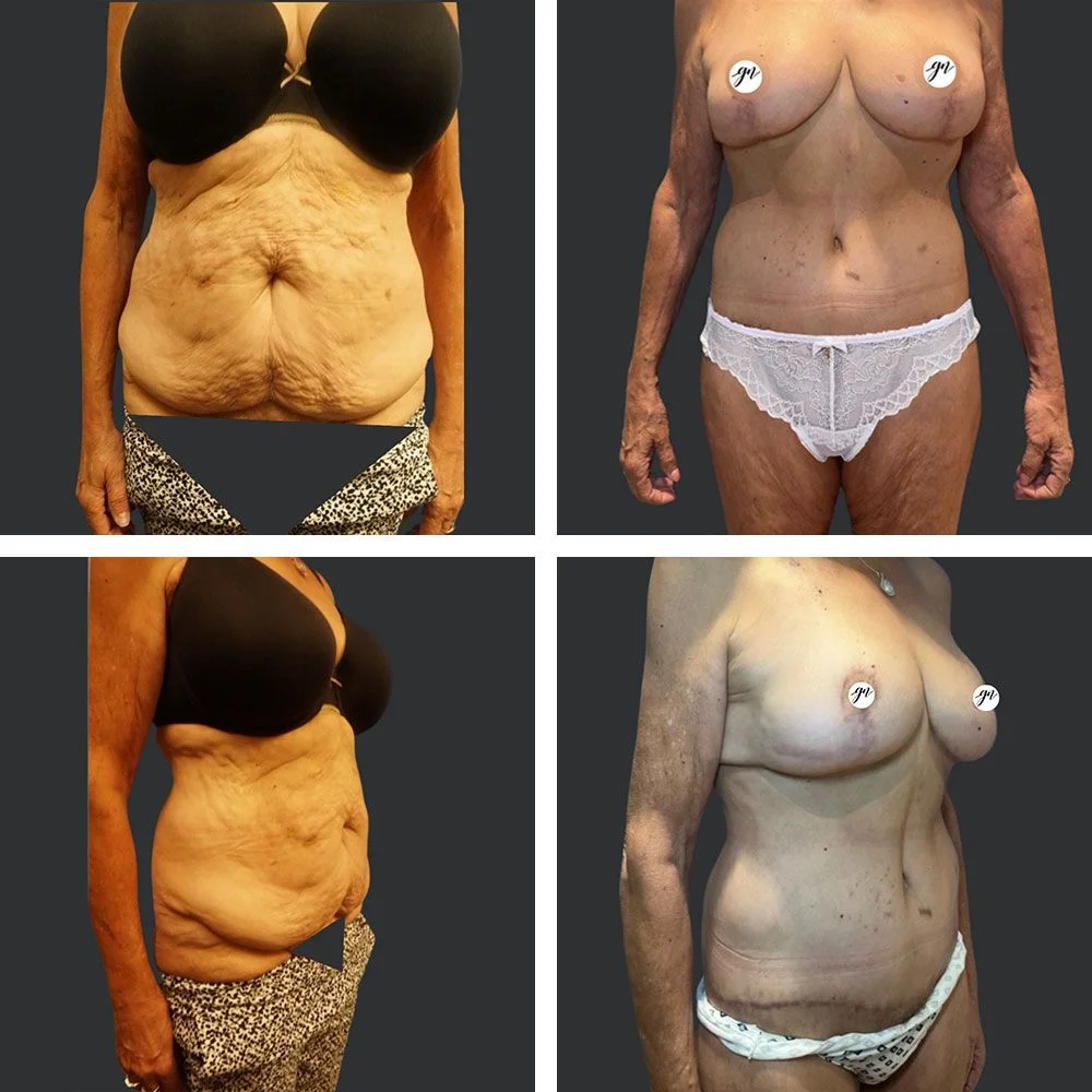 Mastoplexy Abdominoplasty Patient Results Case 1