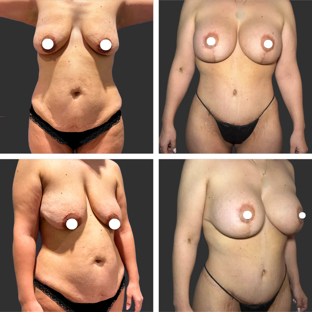 Mommy Makeover Patient Results Case 1