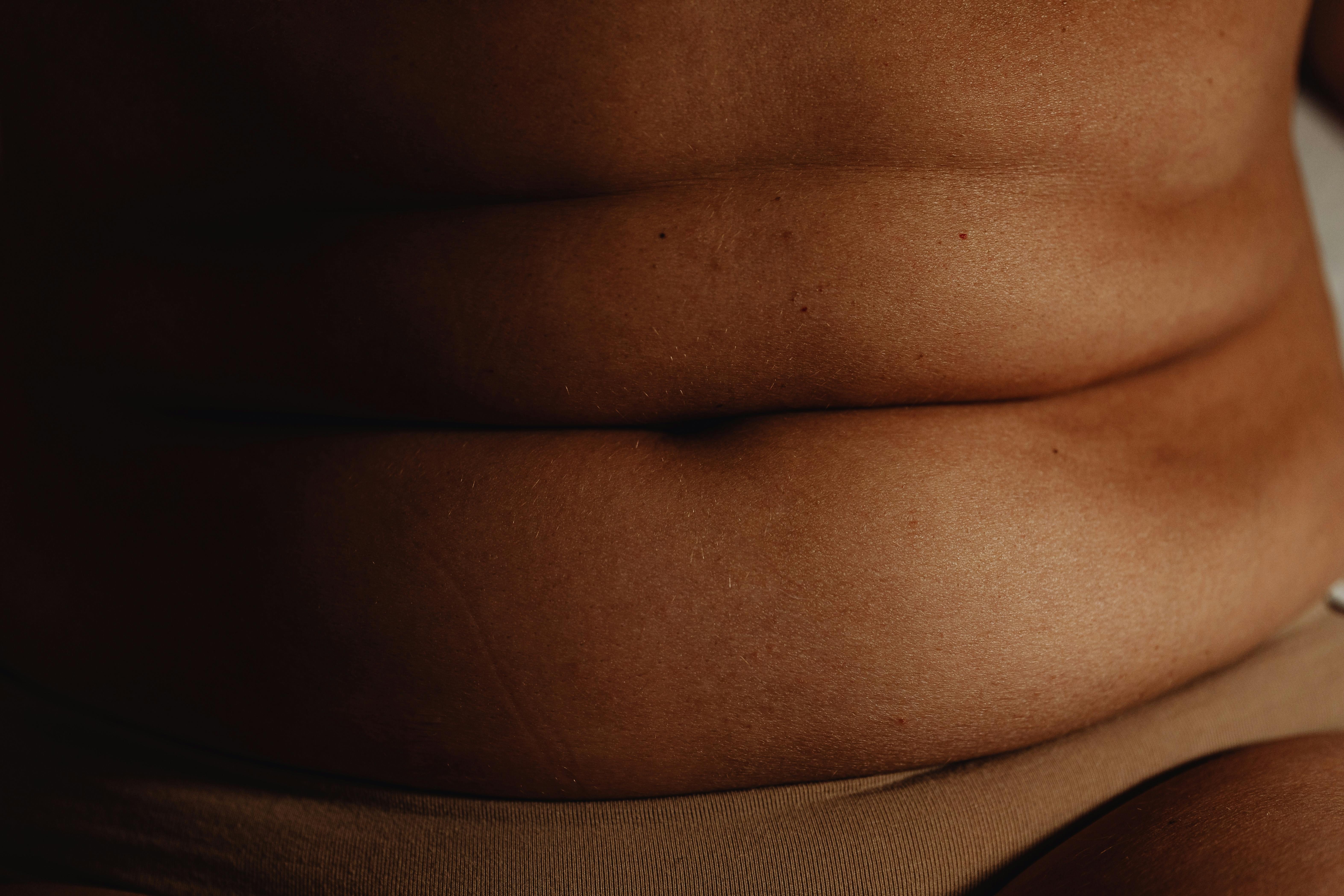 Liposuction - Professional Treatment